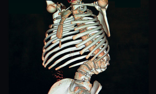 Transform the lives of children with severe spinal deformities around the world