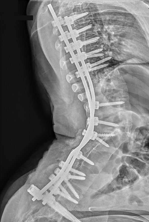Post-Op