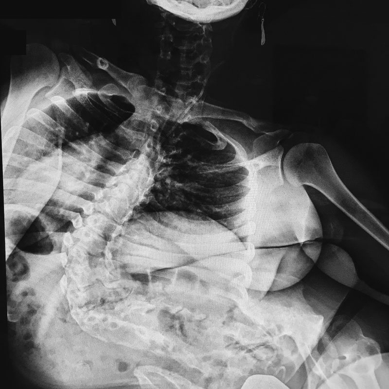 Pre-Op