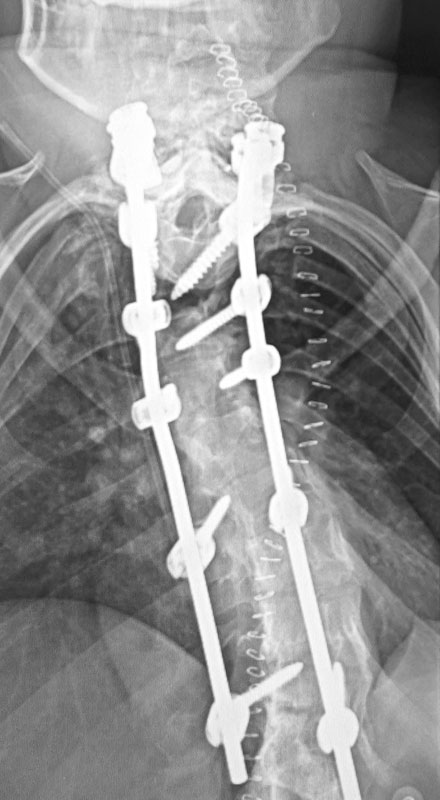 Post-Op